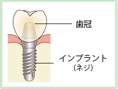 インプラントとは　歯冠、インプラント（ネジ）